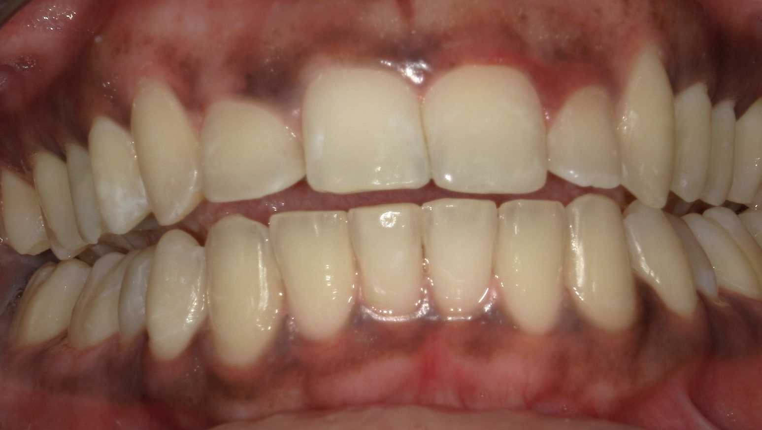 Ortodonzia - Dopo