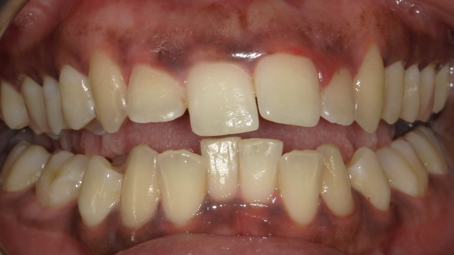 Ortodonzia - Prima
