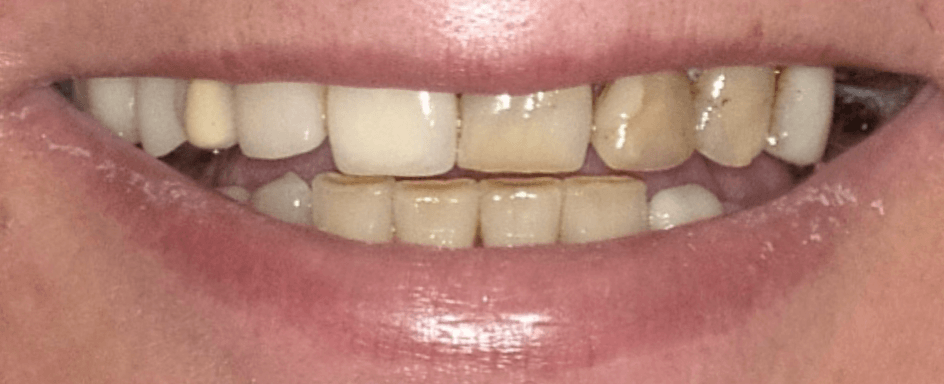 Denti naturali prima