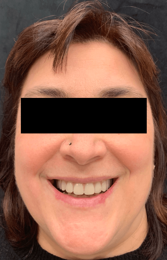 Riabilitazione superiore con denti fissi su impianti