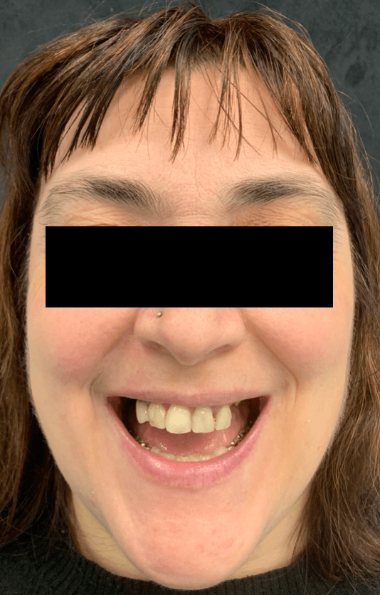 Assenza dei denti posteriori e denti anteriori mobili